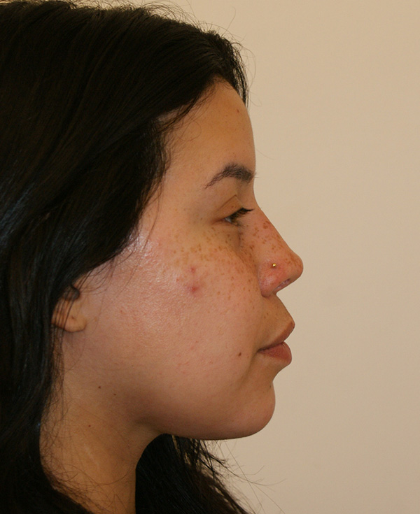 Photo of Patient 22 After Nose Procedure
