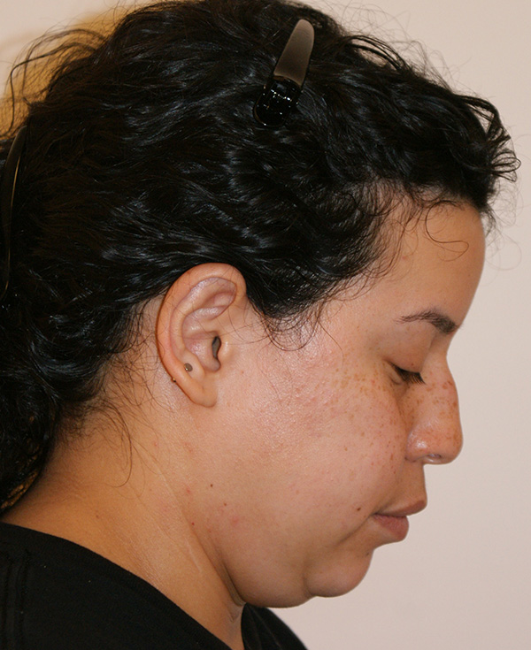 Photo of Patient 22 Before Nose Procedure