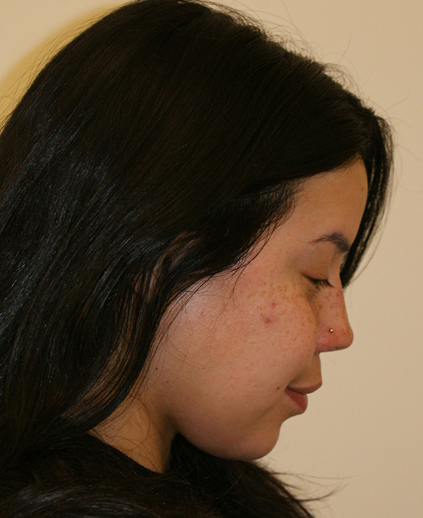 Photo of Patient 22 After Nose Procedure