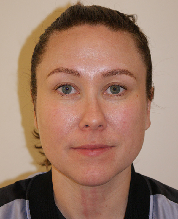 Nose Before and After | Dino Elyassnia, MD