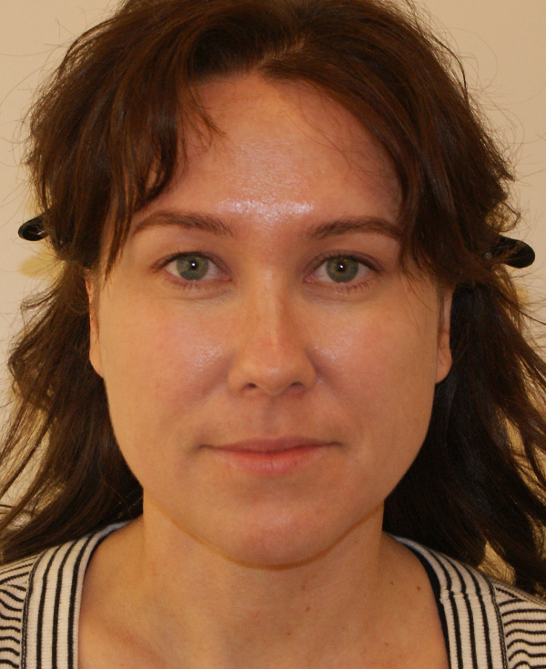 Nose Before and After | Dino Elyassnia, MD