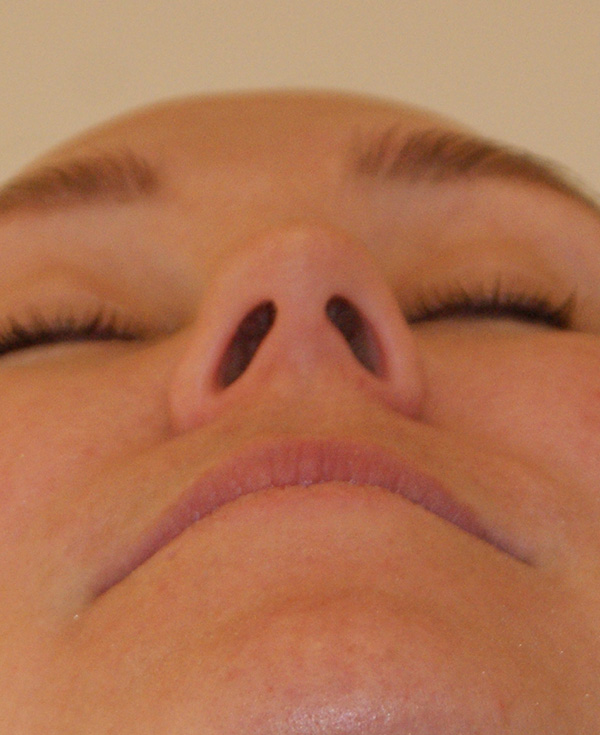 Photo of Patient 23 Before Nose Procedure