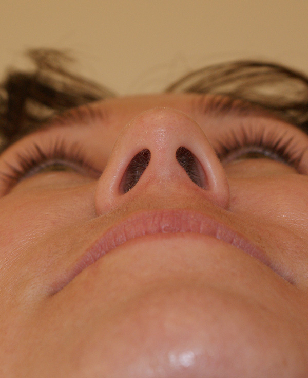 Photo of Patient 23 After Nose Procedure