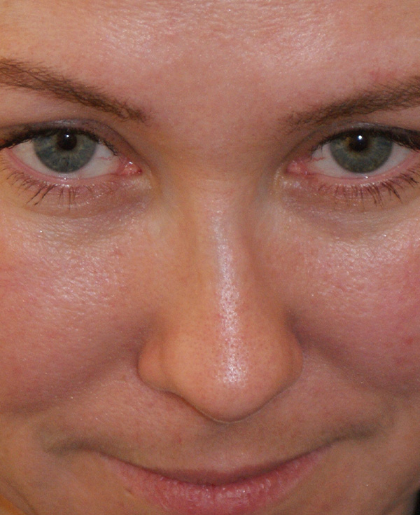 Photo of Patient 23 Before Nose Procedure