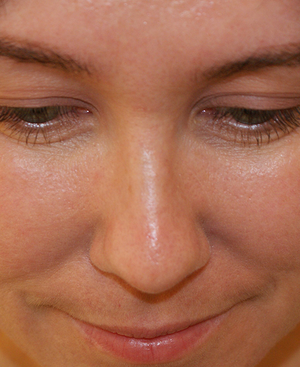 Photo of Patient 23 After Nose Procedure