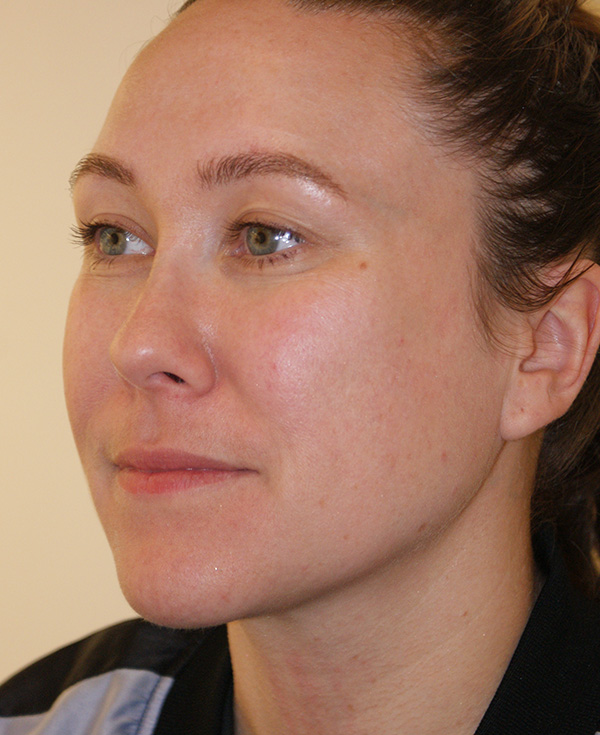 Photo of Patient 23 Before Nose Procedure