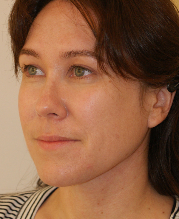 Photo of Patient 23 After Nose Procedure