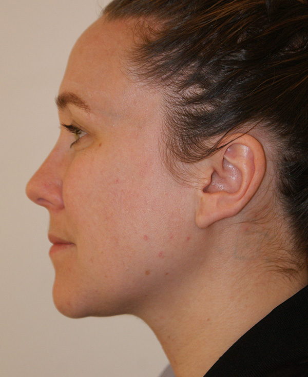 Photo of Patient 23 Before Nose Procedure