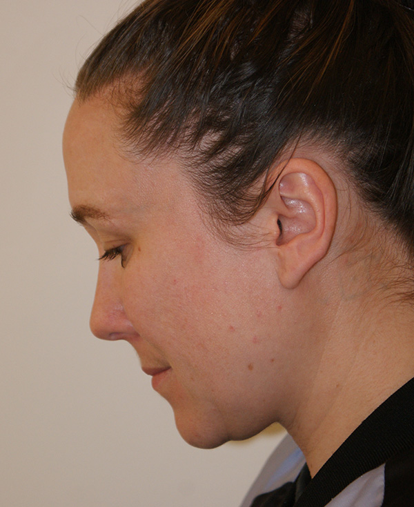 Photo of Patient 23 Before Nose Procedure