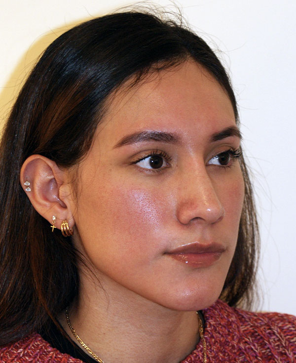 Photo of Patient 24 After Nose Procedure