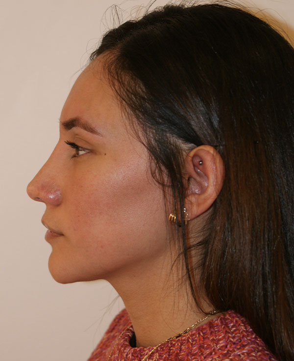 Photo of Patient 24 After Nose Procedure