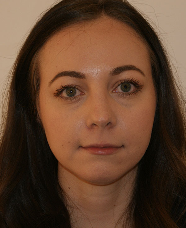 Nose Before and After | Dino Elyassnia, MD