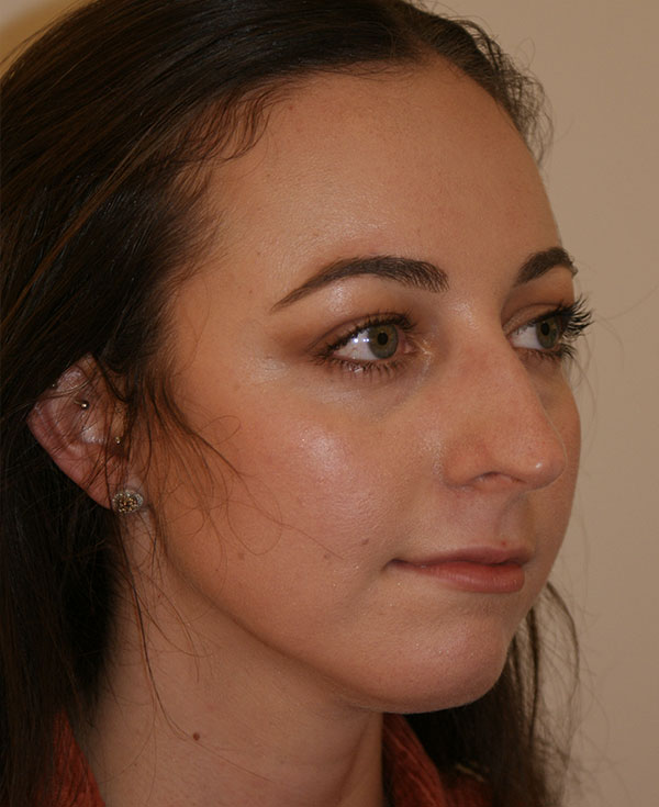 Photo of Patient 25 Before Nose Procedure