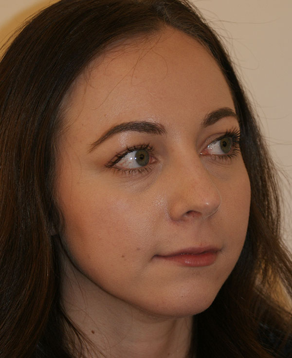 Photo of Patient 25 After Nose Procedure