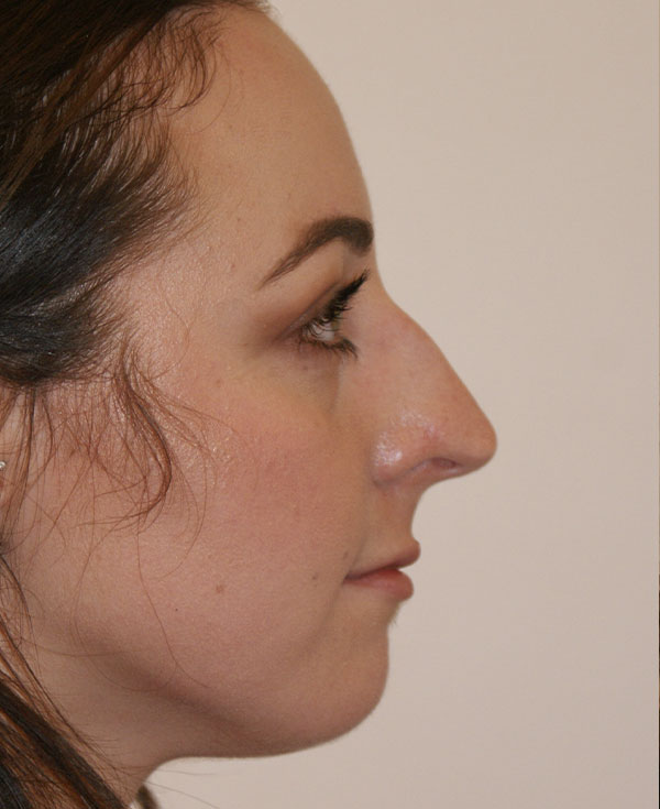 Photo of Patient 25 Before Nose Procedure