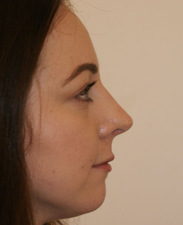 Photo of Patient 25 After Nose Procedure