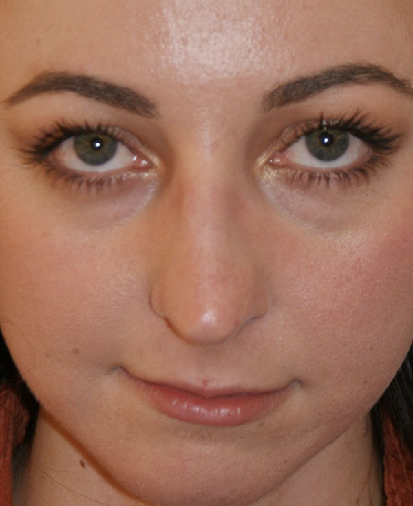 Photo of Patient 25 Before Nose Procedure