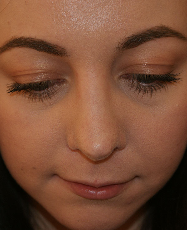 Photo of Patient 25 After Nose Procedure