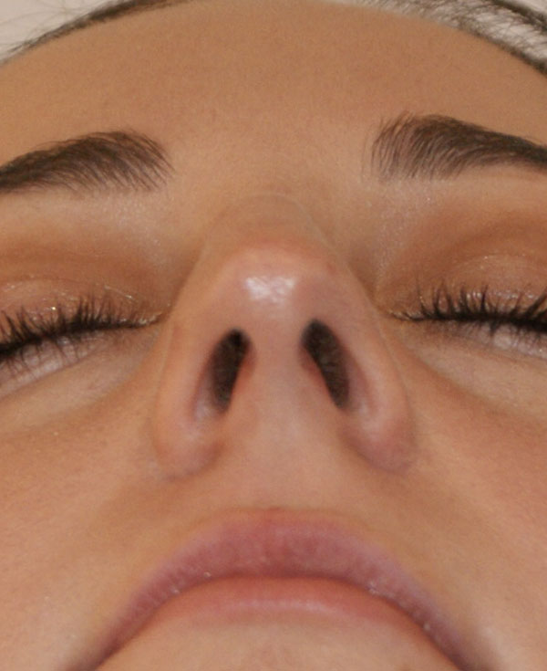 Photo of Patient 25 Before Nose Procedure