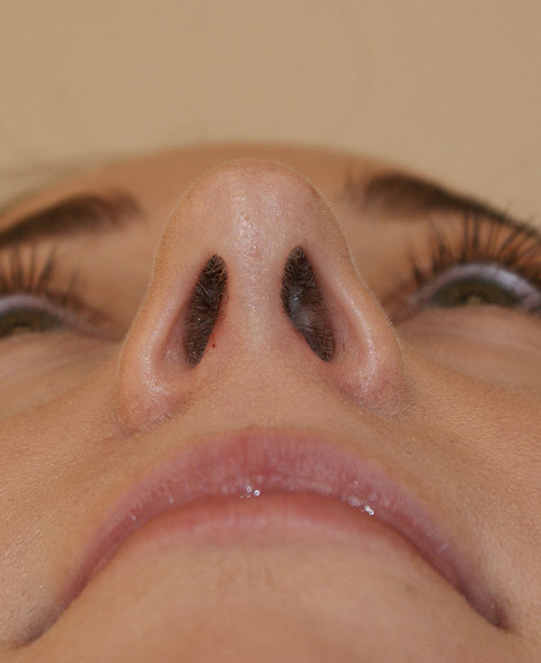 Photo of Patient 25 After Nose Procedure