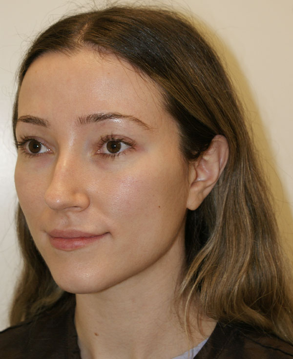 Photo of Patient 26 Before Nose Procedure