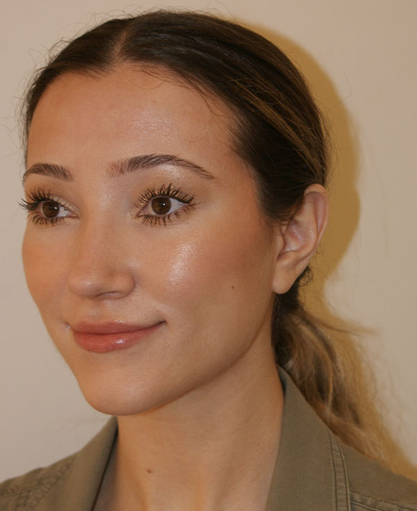 Photo of Patient 26 After Nose Procedure