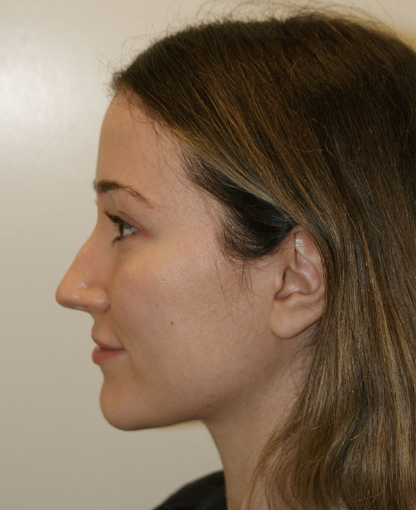 Photo of Patient 26 Before Nose Procedure