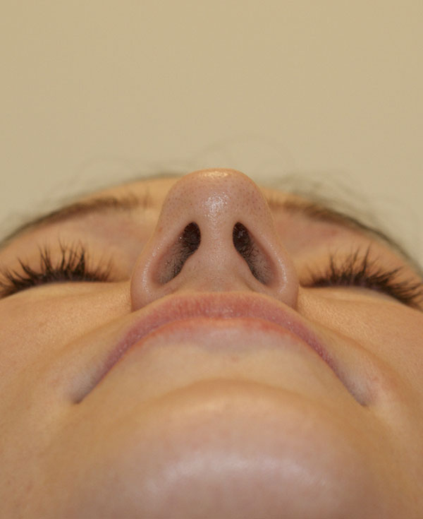 Photo of Patient 26 Before Nose Procedure