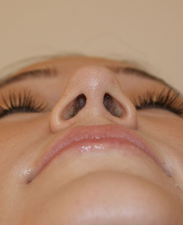 Photo of Patient 26 After Nose Procedure