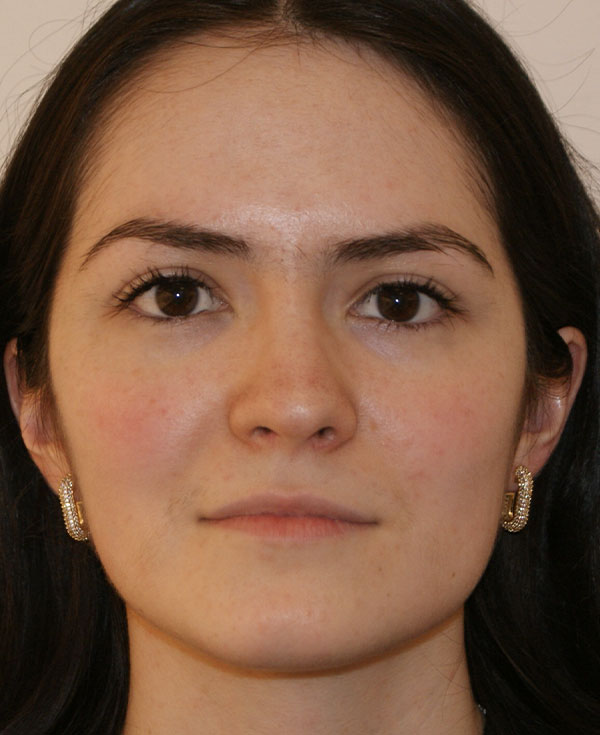 Nose Before and After | Dino Elyassnia, MD