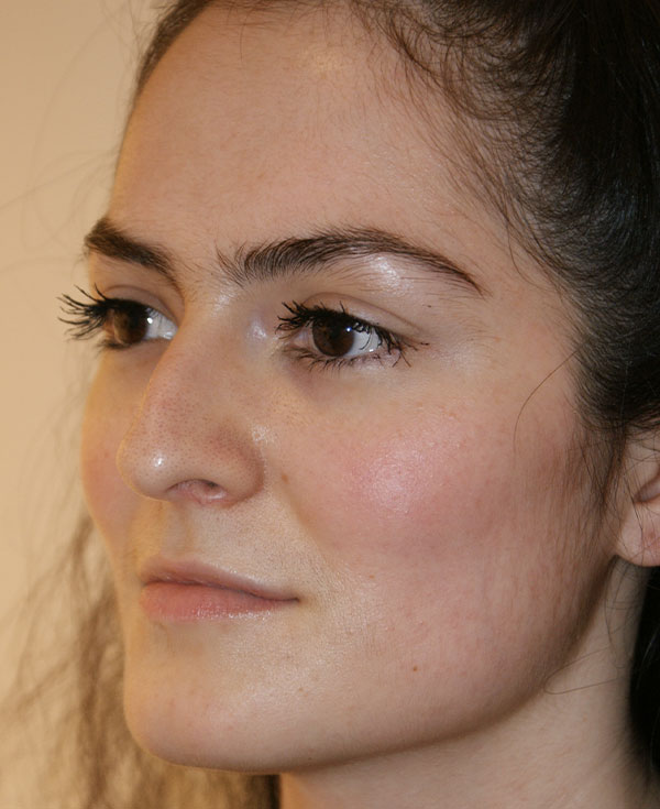 Photo of Patient 27 Before Nose Procedure