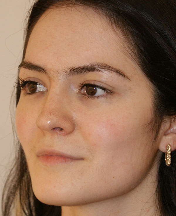 Photo of Patient 27 After Nose Procedure