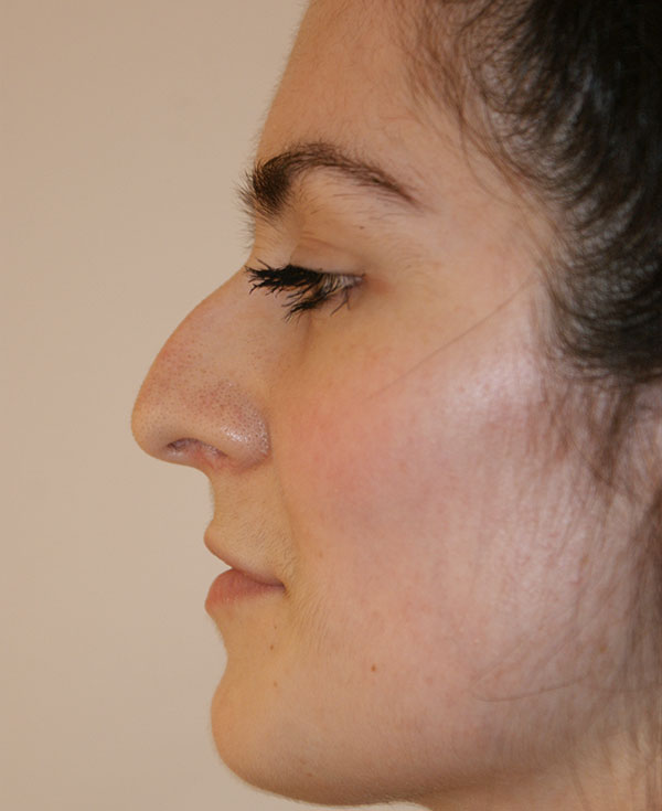 Photo of Patient 27 Before Nose Procedure