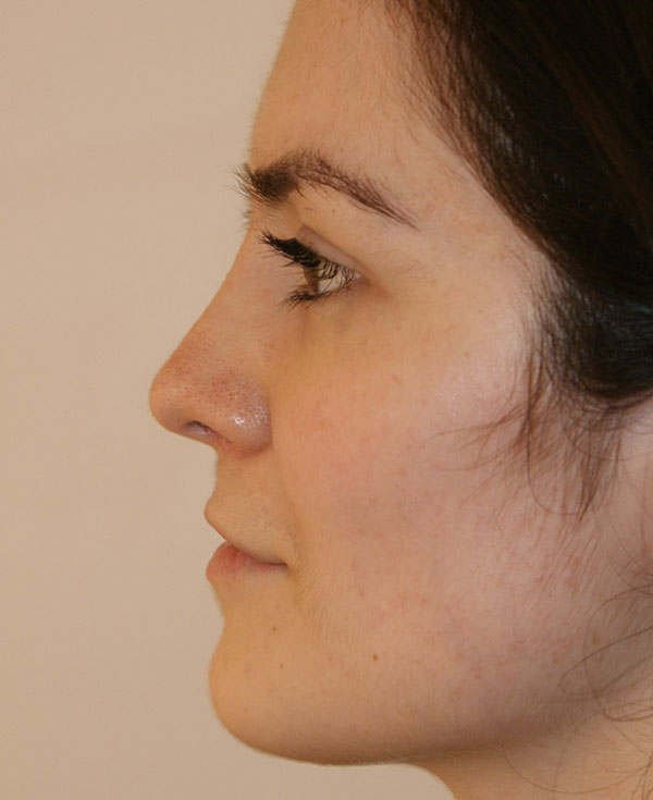 Photo of Patient 27 After Nose Procedure