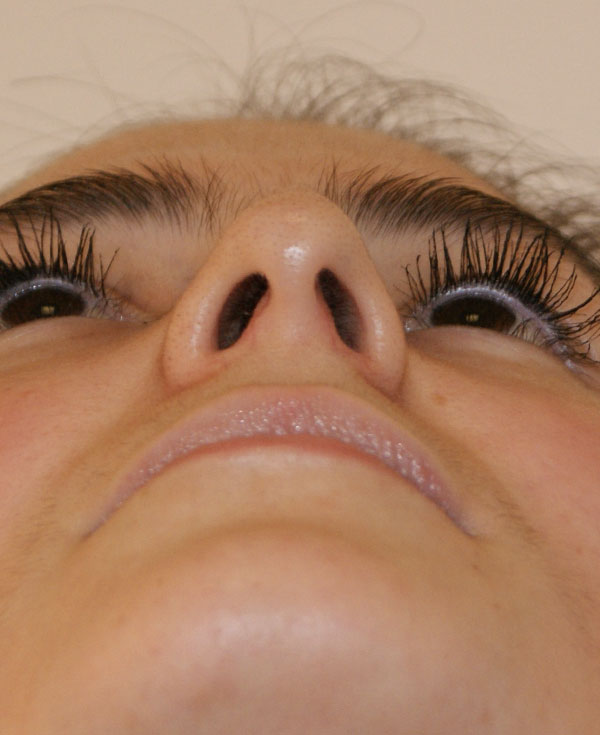 Photo of Patient 27 Before Nose Procedure