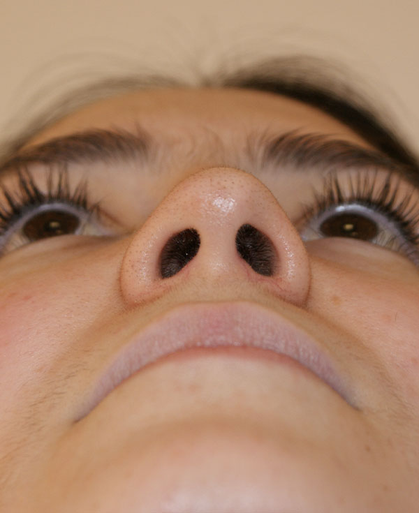 Photo of Patient 27 After Nose Procedure