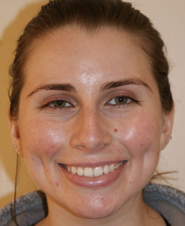 Nose Before and After | Dino Elyassnia, MD