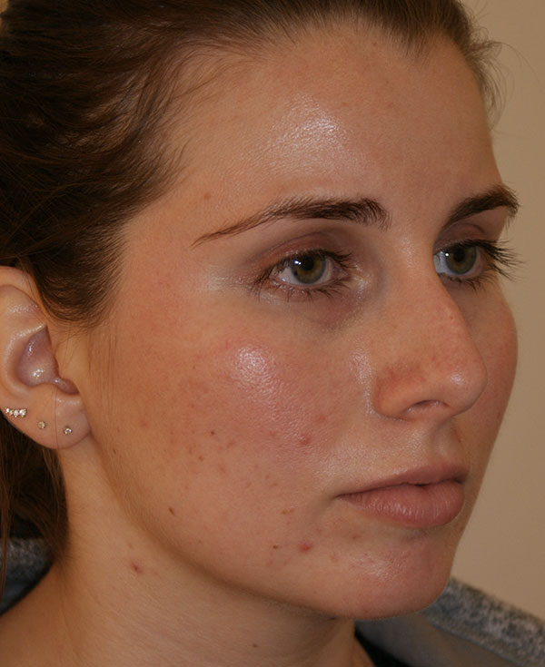 Photo of Patient 28 Before Nose Procedure