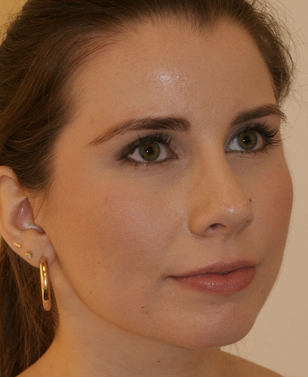 Photo of Patient 28 After Nose Procedure