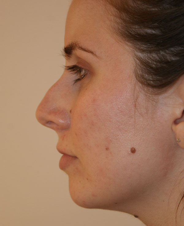 Photo of Patient 28 Before Nose Procedure