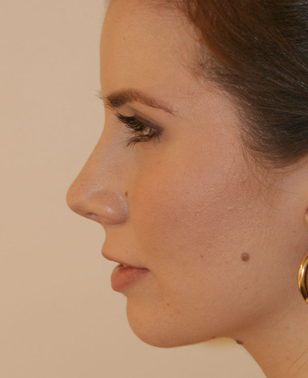 Photo of Patient 28 After Nose Procedure