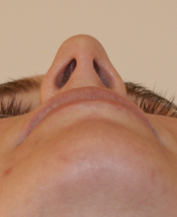 Photo of Patient 28 Before Nose Procedure