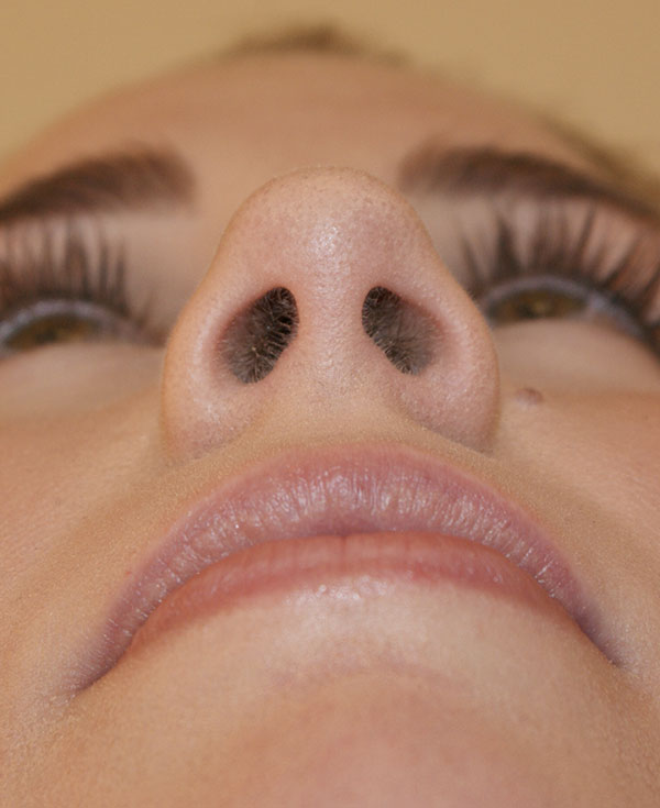 Photo of Patient 28 After Nose Procedure