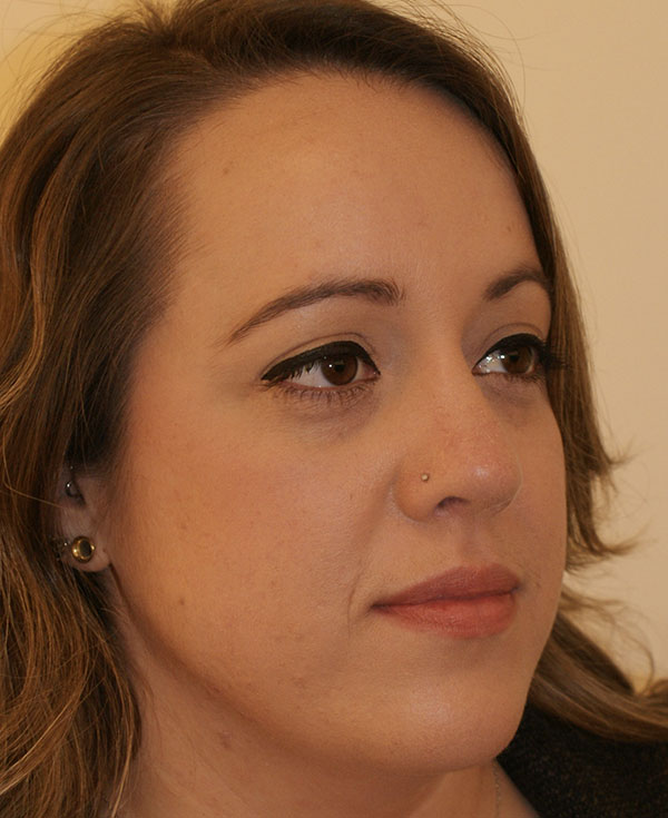 Photo of Patient 29 After Nose Procedure