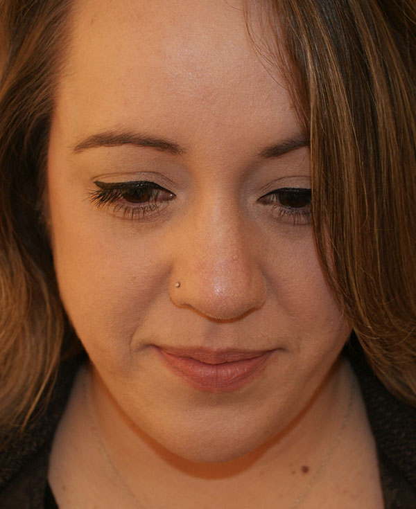 Photo of Patient 29 After Nose Procedure