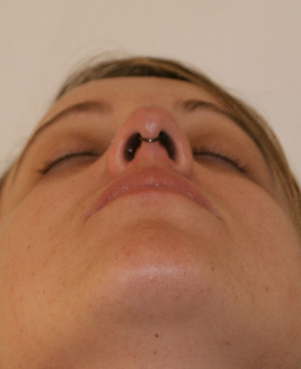 Photo of Patient 29 Before Nose Procedure