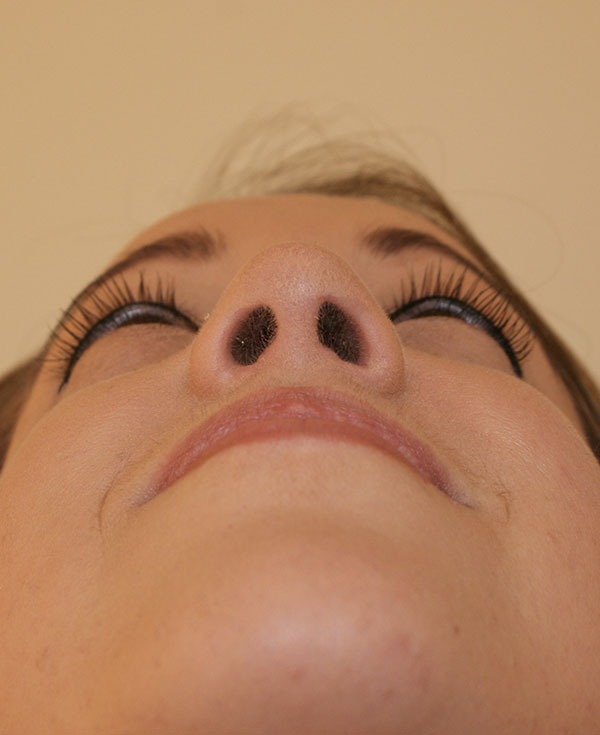 Photo of Patient 29 After Nose Procedure