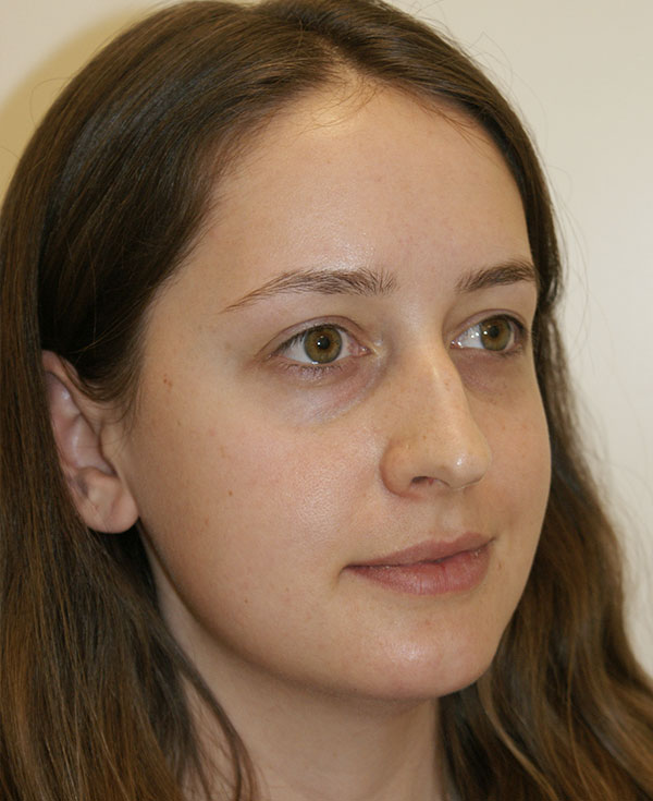 Photo of Patient 30 Before Nose Procedure