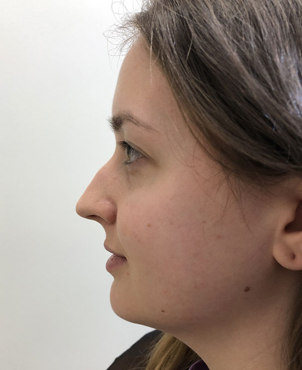 Photo of Patient 30 Before Nose Procedure