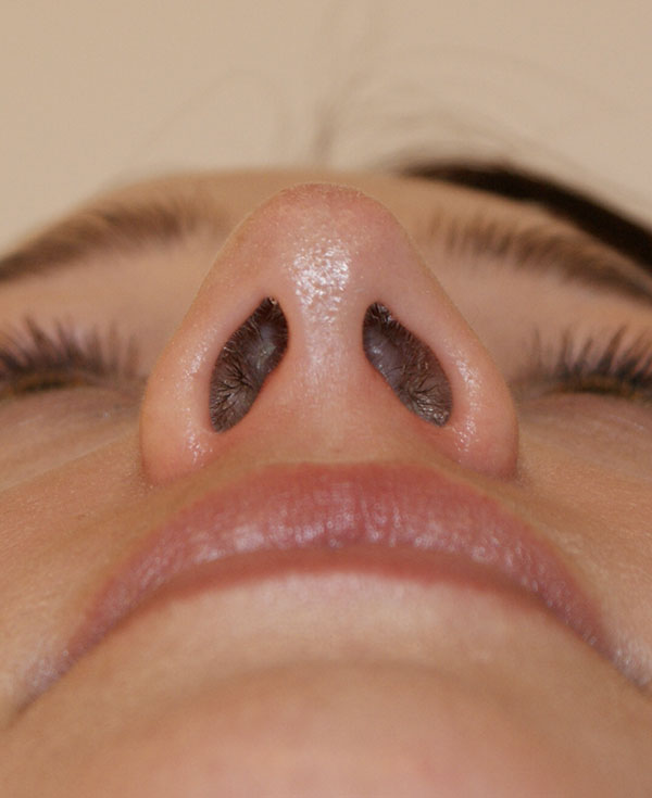 Photo of Patient 30 After Nose Procedure